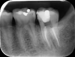 Root fill x-ray